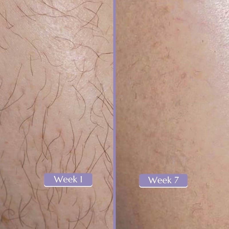 ICE IPL Hair Removal Handset
